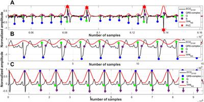 Robust Identification of the QRS-Complexes in Electrocardiogram Signals Using Ramanujan Filter Bank-Based Periodicity Estimation Technique